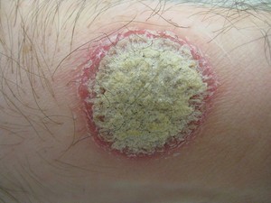 Psoriasis plaque